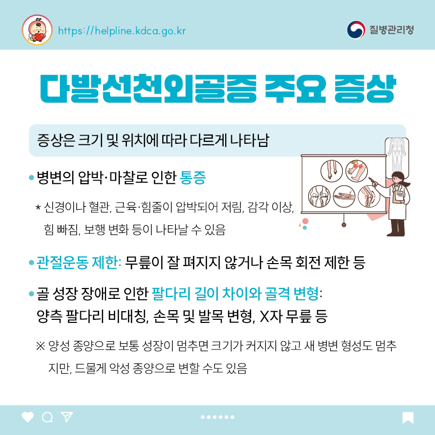 다발선천외골증 주요 증상  증상은 크기 및 위치에 따라 다르게 나타남 - 병변의 압박&middot;마찰로 인한 통증   * 신경이나 혈관, 근육&middot;힘줄이 압박되어 저림, 감각이상, 힘 빠짐, 보행 변화 등이 나타날 수 있음 - 관절운동 제한: 무릎이 잘 펴지지 않거나 손목 회전 제한 등 - 골 성장 장애로 인한 팔다리 길이 차이와 골격 변형: 양측 팔다리 비대칭, 손목 및 발목 변형, X자 무릎 등  ※ 양성 종양으로 보통 성장이 멈추면 크기가 커지지 않고 새 병변 형성도 멈추지만, 드물게 악성 종양으로 변할 수도 있음